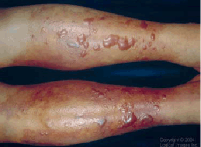 Primary septicemic skin lesions caused by Vibrio vulnificus. Photo courtesy of CDC