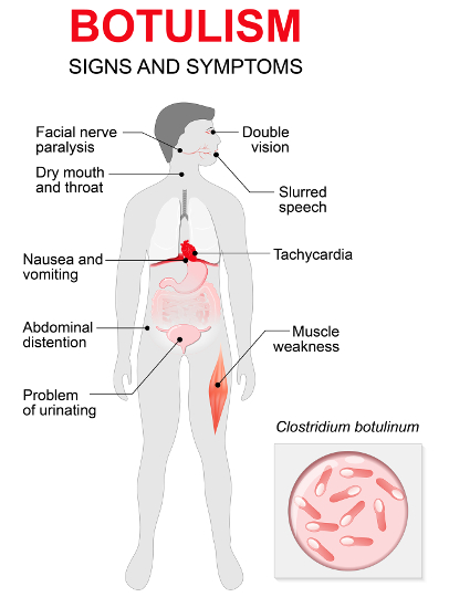 Botulism outbreak raises public health concerns in California | Food Safety  News