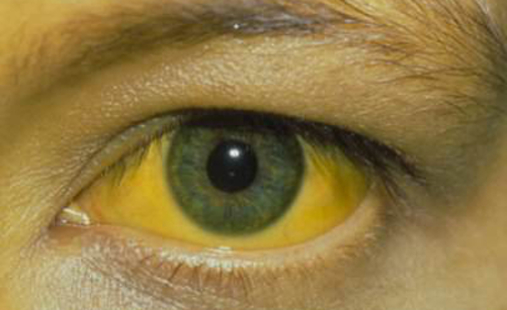 yellow jaundice eye hepatitis A