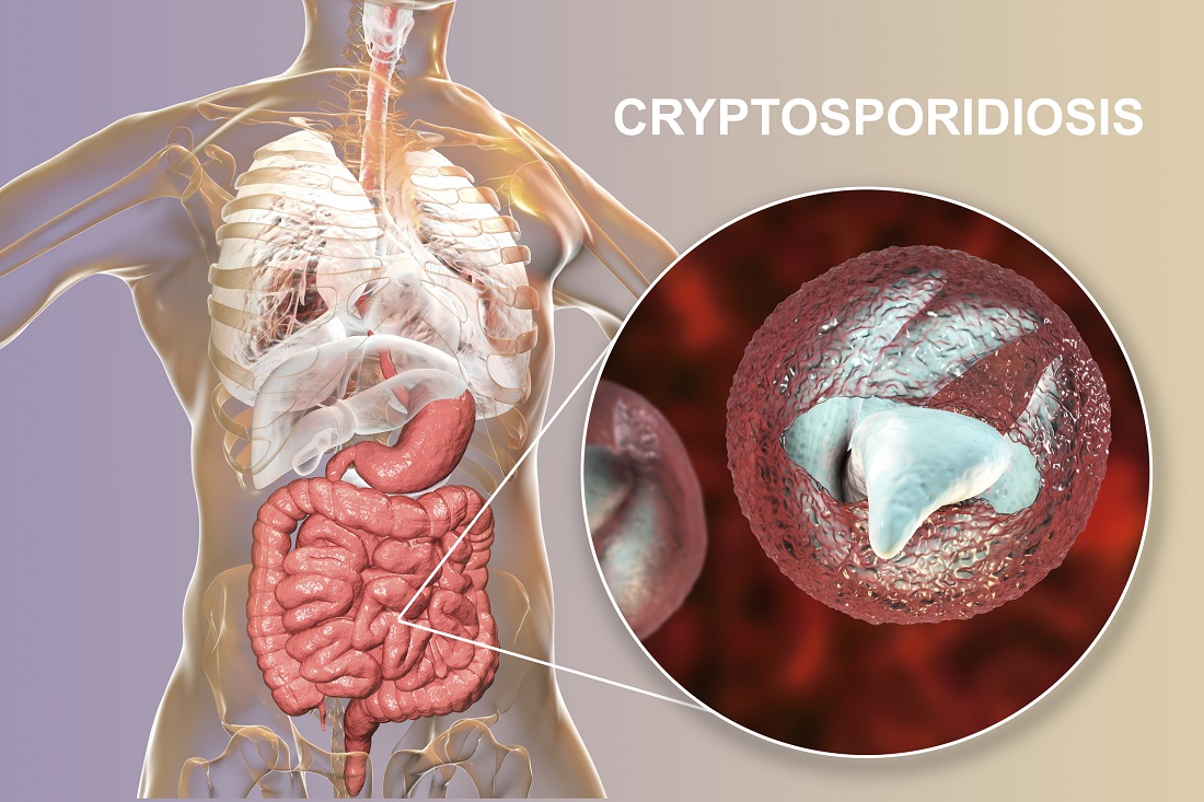 Cryptosporidiosis