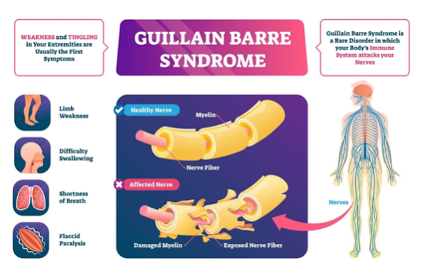 Guillain Barre