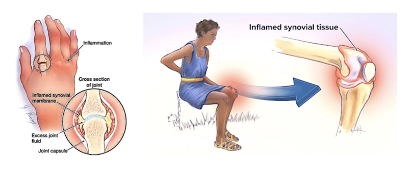 Reactive Arthritis Rea