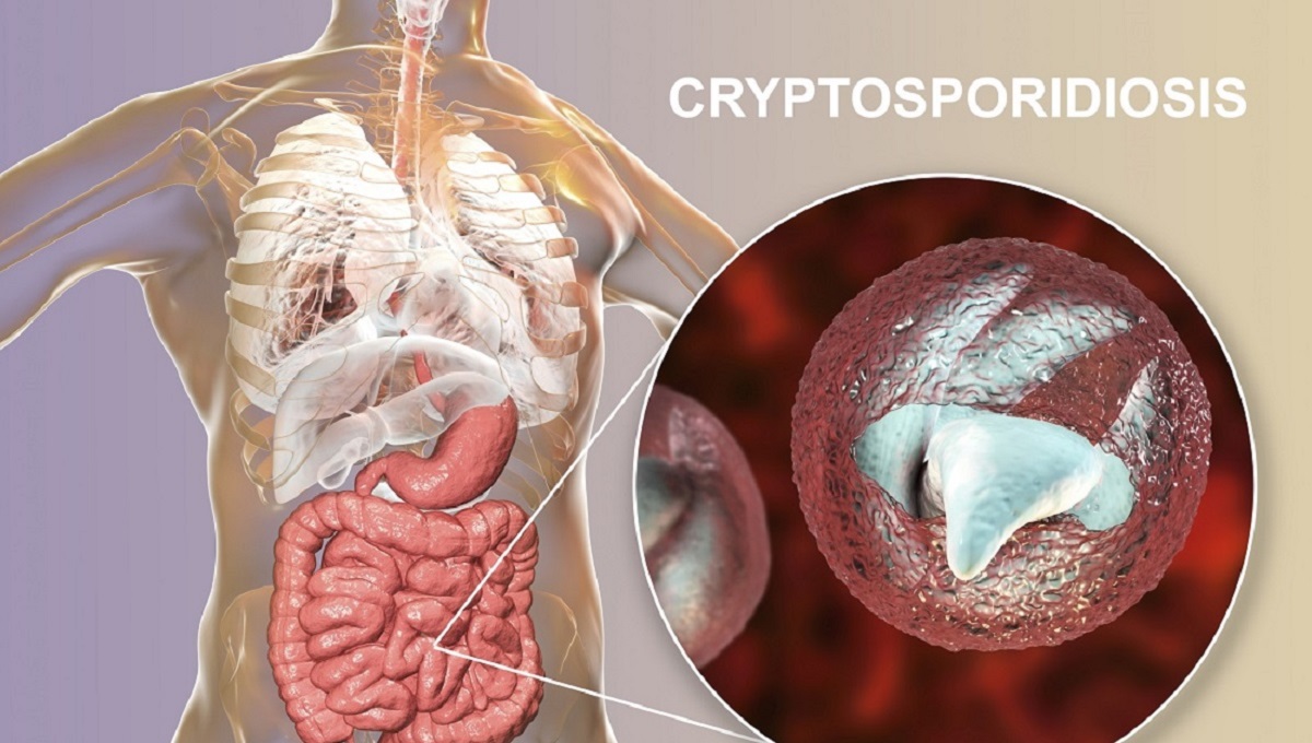 Cryptosporidiosis, a diarrheal disease caused by Cryptosporidium parvum protozoan